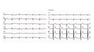 Beyaz arka planda normal insan elektrokardiyogramı ya da EKG 12 çizimi. Vektör illüstrasyonu.