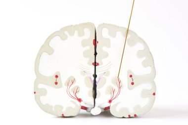 Globus pallidus interna ya da Parkinson 'daki GPi' nin mikroelektrot kaydı. Beyaz zemin üzerinde beyin modeli ve elektrot.