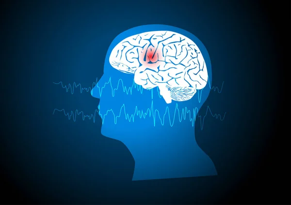 Ohniskový Záchvat Ilustrace Lidského Mozku Elektroencefalografie Nebo Eeg Pocházející Jednoho — Stockový vektor