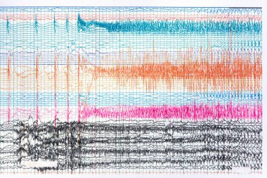 Nöbet sırasında iktal EEG kaydının fotoğrafı. Yüksek genlik ve frekans dalgalarının yayılımını gösteren nöbet dalgaları.