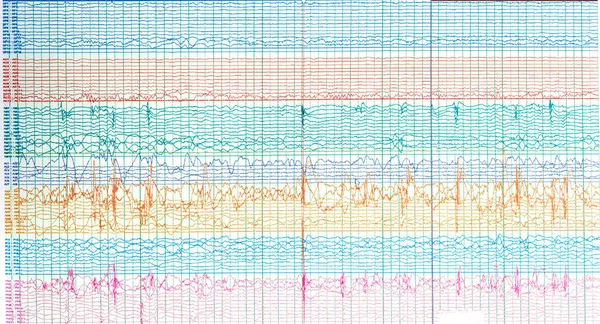 Фотография Мозговых Волн Пациента Эпилепсией Показывающая Резкую Волну Припадка Интериктальной — стоковое фото