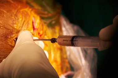 Nörocerrah elinde şırınga tutarken sinir cerrahisi sırasında apselerden irin alıyor. 