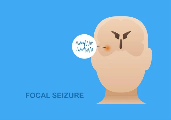 Temporal Lobe Epilepsy Vector Illustration Human Focal Seizure Abnormal Brain — Stock vektor