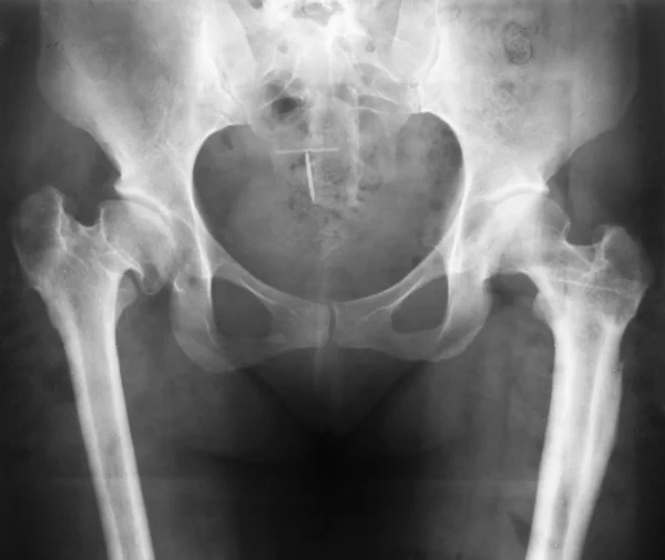 X-ray of deformed hip — Stock Photo, Image