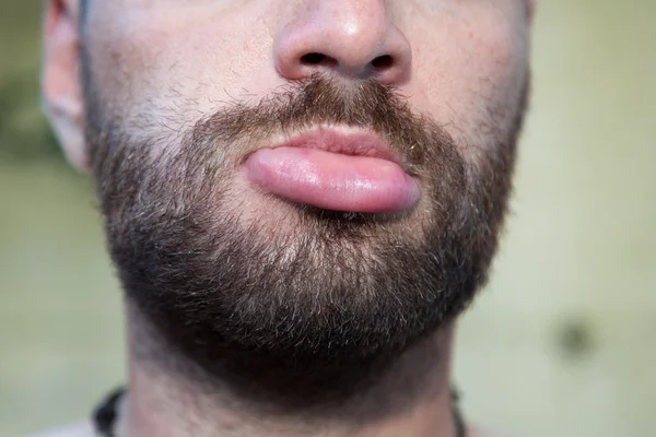 Man with swollen lip