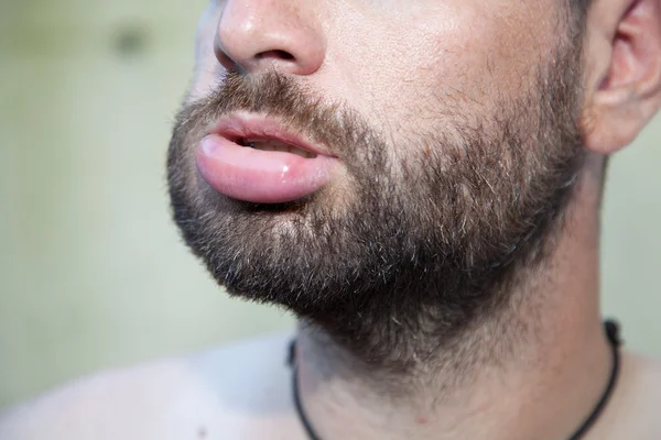 Lábios inchados — Fotografia de Stock