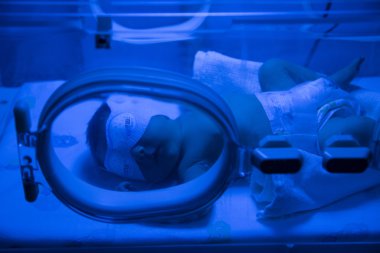 Newborn Baby having UVB phototherapy treatment for jaundice clipart