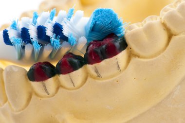 Casting of teeth model and toothbrush, Showing How to brush the 