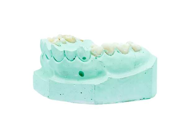 Denture cast model — Stock Photo, Image