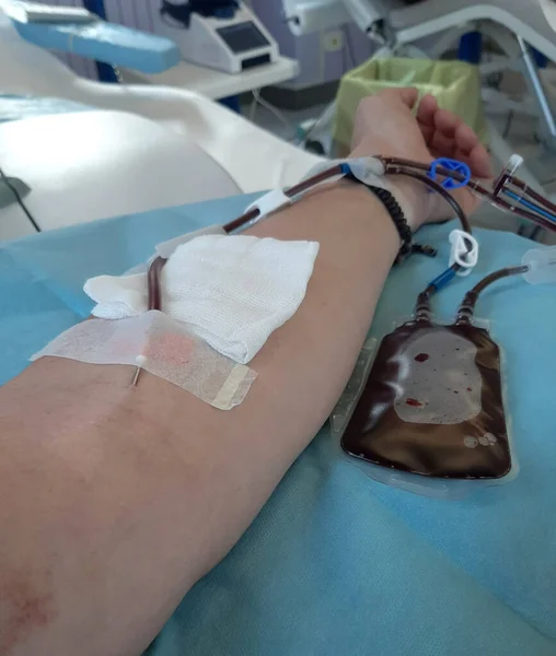 Brazo Adulto Voluntario Durante Donación Sangre Para Recolección Plaquetas Llamada — Foto de Stock