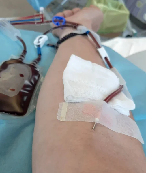 Brazo Adulto Voluntario Durante Donación Sangre Para Recolección Plaquetas Llamada — Foto de Stock