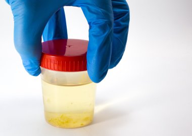 Doktor analisti için idrar tahlili idrar örneği alır