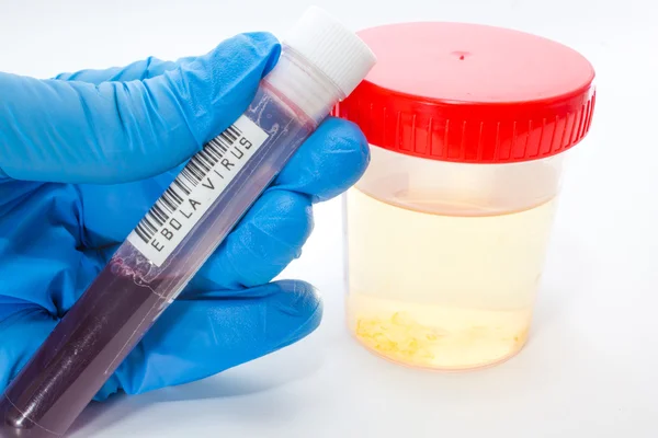 Seringue avec sang pour analyses de sang et tube d'analyse d'urine — Photo