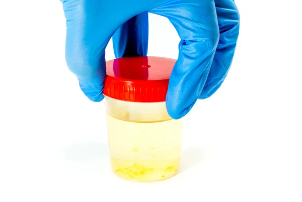 Analyste de laboratoire prélève l'échantillon d'urine pour analyse d'urine — Photo