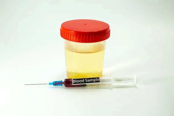 Blood to be analyzed and a specimen of urine — Stock Photo, Image