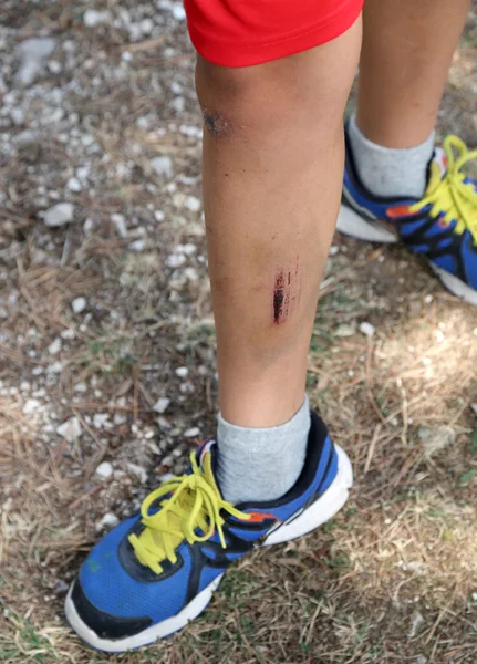 Enfant avec la jambe blessée après la chute désastreuse — Photo