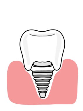 Diş implantları, dişçi illüstrasyonu, simge.