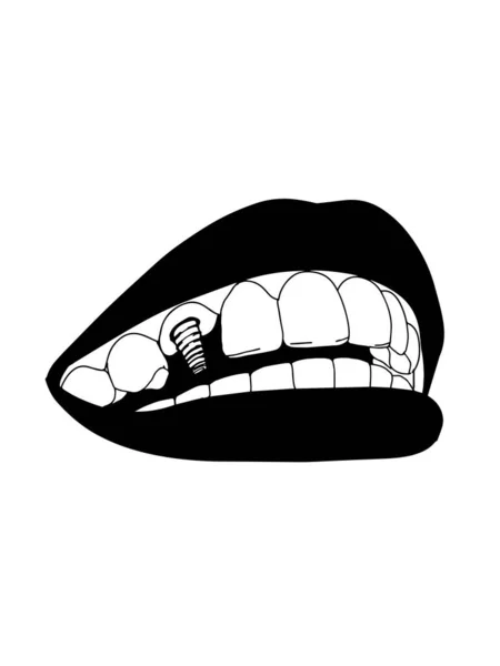 Bocca Femminile Impianto Dentale Denti Illustrazione Colori Bianco Nero — Foto Stock