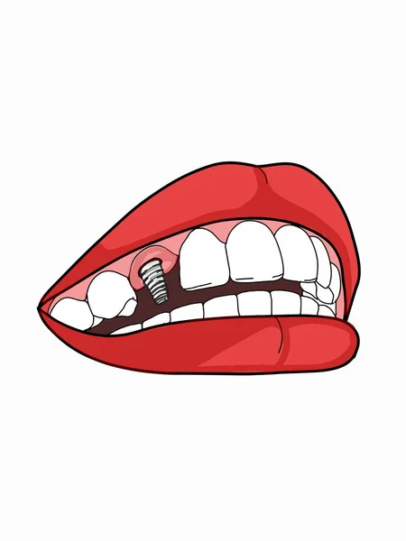Kadın ağzı, diş implantı, diş implantı, illüstrasyon.. 
