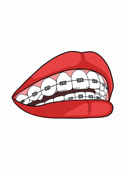 Γυναικείο Στόμα Δόντια Και Οδοντικά Στηρίγματα Εικονογράφηση — Φωτογραφία Αρχείου