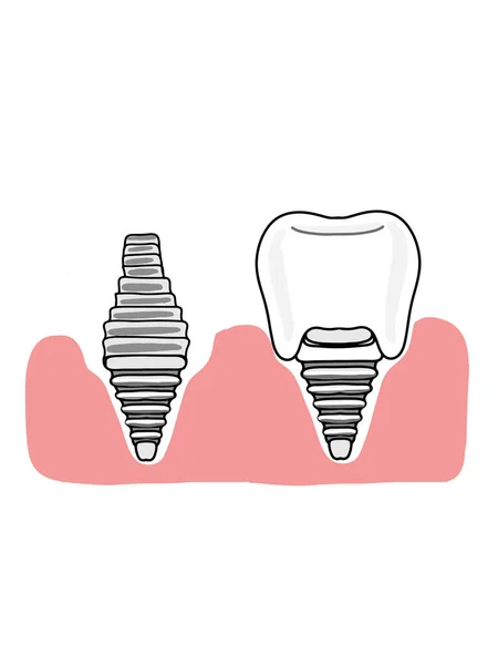 Implantes Dentários Ilustração Gengival Ícone — Fotografia de Stock