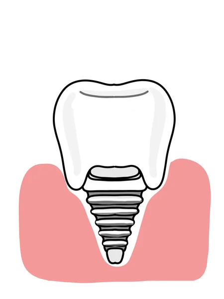 Zubní Implantáty Dásní Ilustrace Ikona — Stock fotografie
