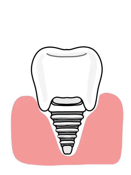 Diş implantları, dişçi illüstrasyonu, simge.