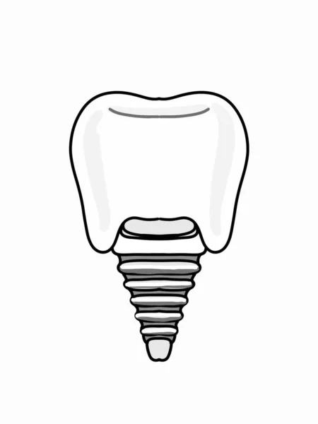 Implantes Dentários Ilustração Ícone — Fotografia de Stock