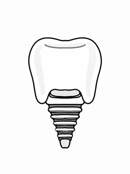 Implantes Dentales Ilustración Icono — Foto de Stock