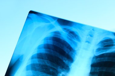 Göğüs X-Ray görüntüsü 