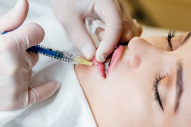 Kadın dudaklarına enjeksiyon yapan kozmetik uzmanının ellerine yakın çekim. Elinde şırınga var. Güzellik uzmanının elleri, kadın dudaklarına enjekte ediliyor..