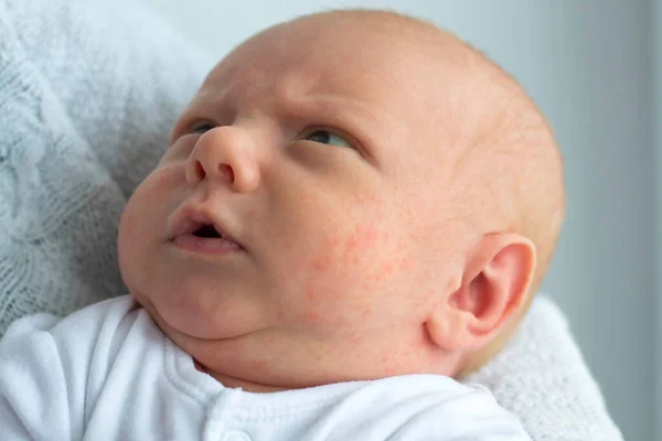 Retrato Bebé Recién Nacido Con Manifestaciones Una Alergia Cara — Foto de Stock