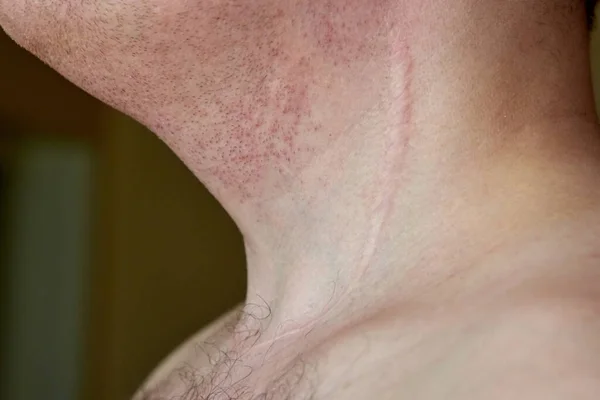 Tiroid Bezini Çıkardıktan Sonra Bir Adamın Boynunda Yara Izi Var — Stok fotoğraf