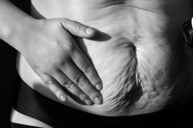 Kadın, besleyici krem sürmüş, sarkık göbeğinde çatlaklar, yakın plan, siyah beyaz fotoğraf....