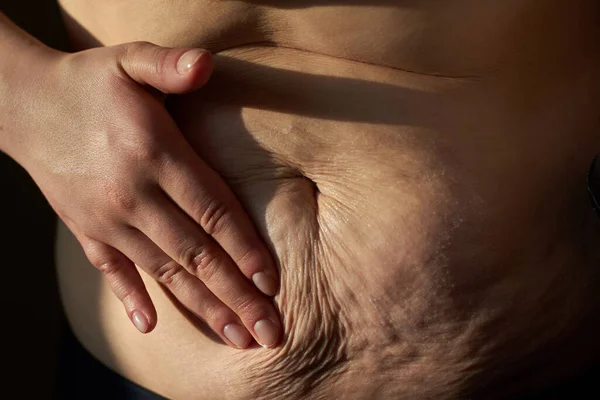 Woman Smears Nutritious Cream Sagging Flabby Belly Stretch Marks Close — Stock Photo, Image