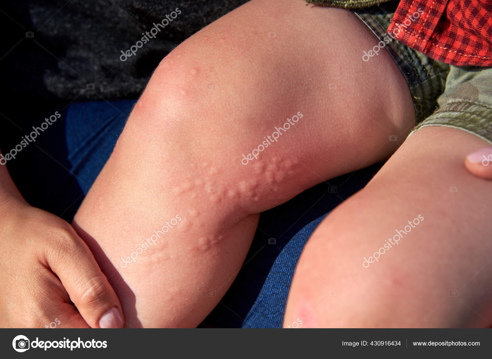 Brûle L'herbe D'ortie Sur Les Jambes Garçon Une Réaction ...