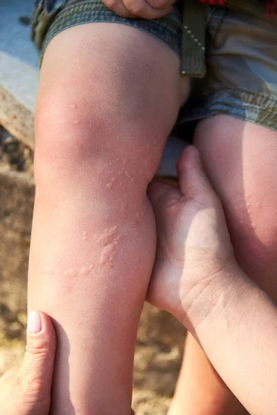 Çocuğun Bacaklarındaki Isırgan Otundan Kaynaklanan Yanıklar Bitkilere Karşı Alerjik Bir — Stok fotoğraf