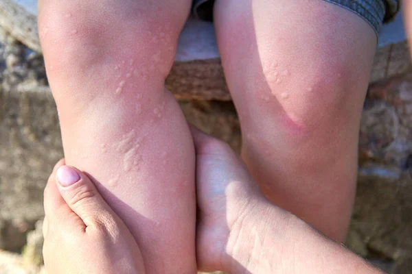 Quemaduras Hierba Ortiga Las Piernas Del Niño Una Reacción Alérgica —  Fotos de Stock