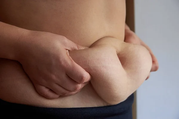 Grasso Smagliature Sulla Pancia Una Donna Obesità Primo Piano — Foto Stock