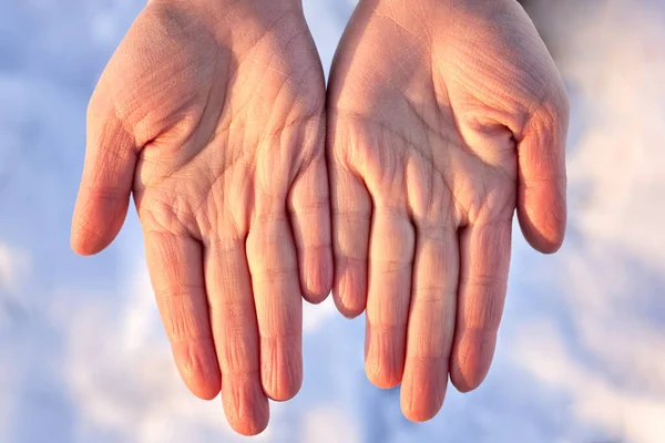 Сухі Жіночі Руки Взимку Тлі Снігу Проблеми Шкірою — стокове фото