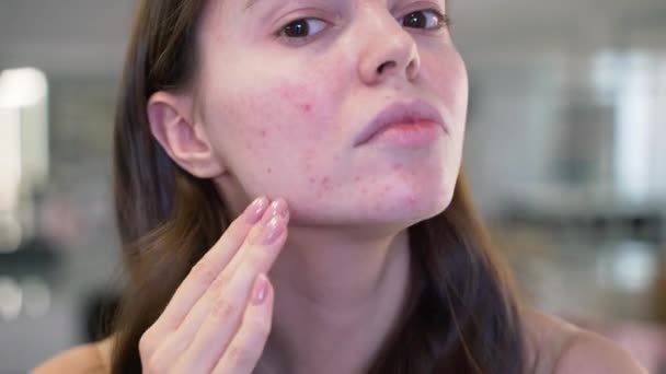 Meisje met het probleem van acne tijdens de puberteit, kijkt naar zichzelf in de spiegel. Close-up — Stockvideo
