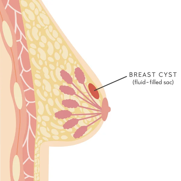 Медицинский инфографический поперечный сечение женской груди с кистой. Анатомия женской груди. Маммарная железа. Информационная карта с нераковой опухолью. Векторная иллюстрация в плоском стиле. — стоковый вектор