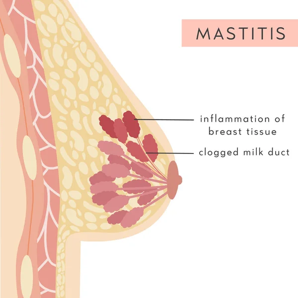 Infografía Médica Enfermedad Mastitis Sección Transversal Mama Femenina Con Inflamación — Vector de stock