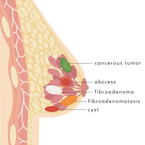 Infographie médicale Coupe transversale du sein féminin avec diverses maladies. Carte d'information avec lésion bénigne et cancéreuse, tumeur ou kyste. Anatomie de la femme Sein avec cancer. Glande mammaire. Vecteur. — Image vectorielle