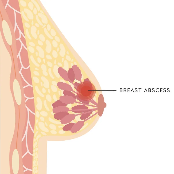 Медицинское инфографическое сечение женской груди с абсцессом. Информационная карта с гноящейся комочкой. Анатомия женской груди с инфекцией. Воспаление молочной железы. Боль. Векторная иллюстрация. — стоковый вектор