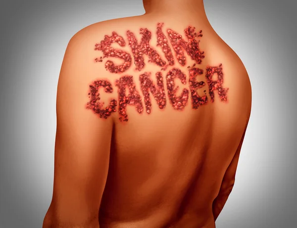 Hud cancer melanom — Stockfoto