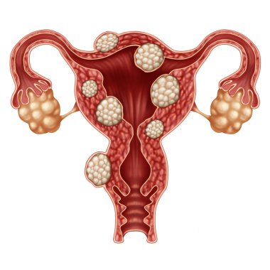 Uterine Fibroid Concept clipart