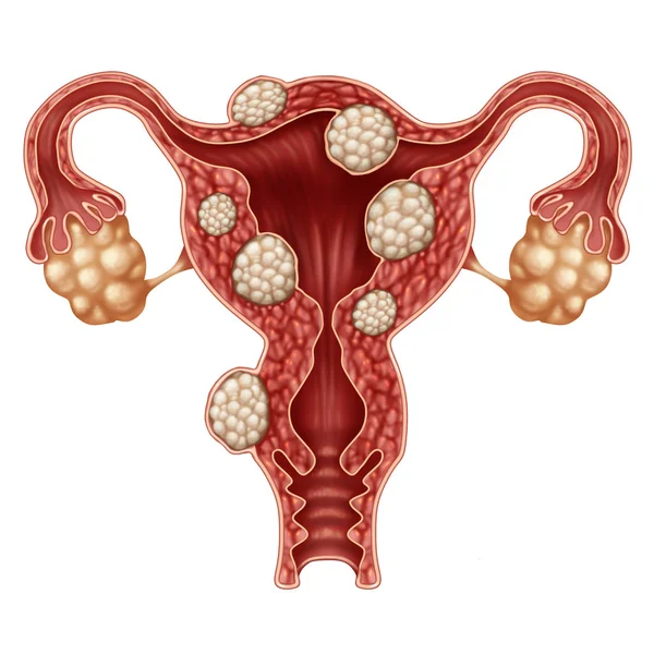 Concetto di fibroma uterino — Foto Stock