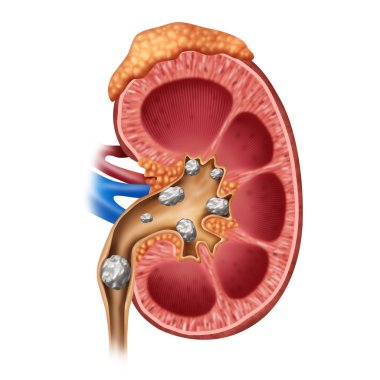 Kidney Stones Symbol clipart