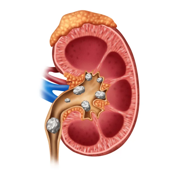 Nierensteine als Symbol — Stockfoto